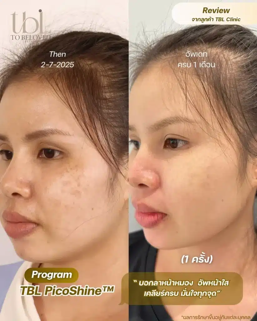 รีวิว Pico Laser ฝ้า