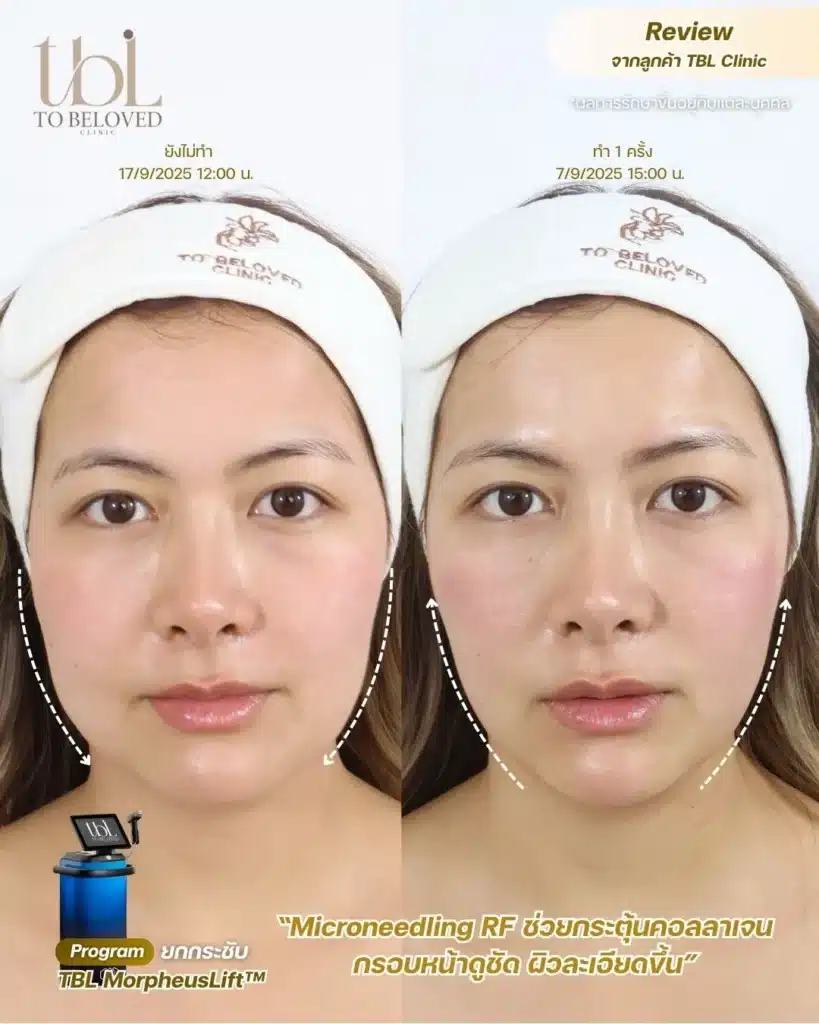 รีวิว ยกกระชับใบหน้า