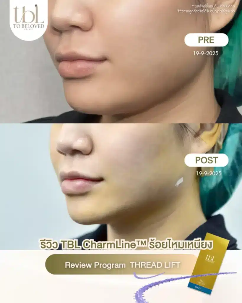 รีวิว ยกกระชับใบหน้า