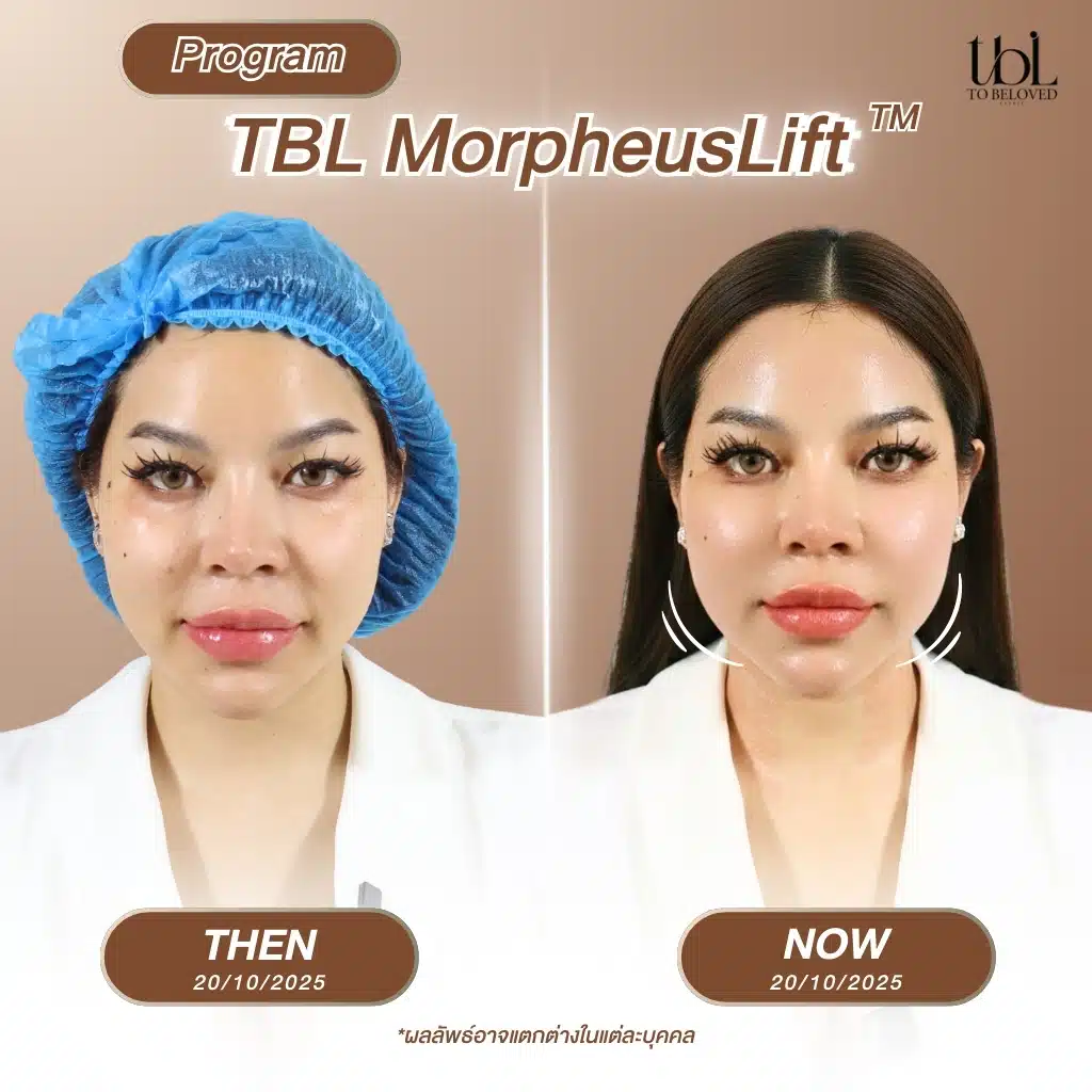 รีวิว Morpheus8