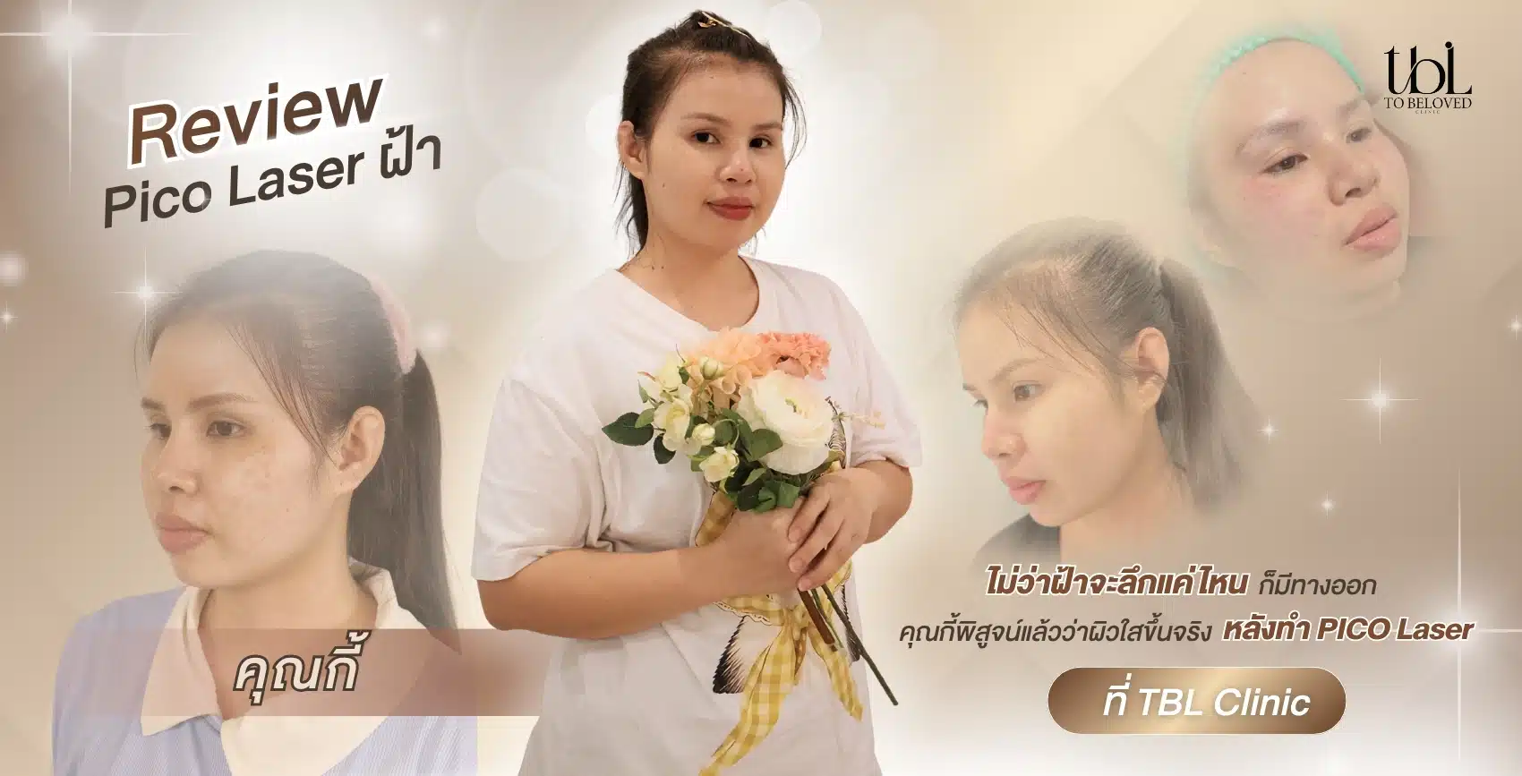 รีวิว Pico Laser ฝ้า