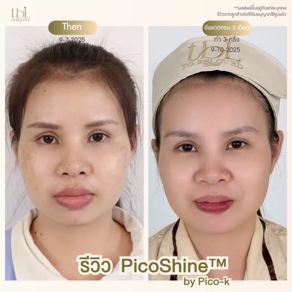 รีวิว pico หน้าใส