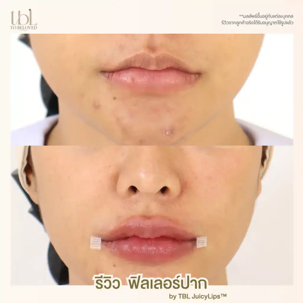 รีวิวฟิลเลอร์ปาก