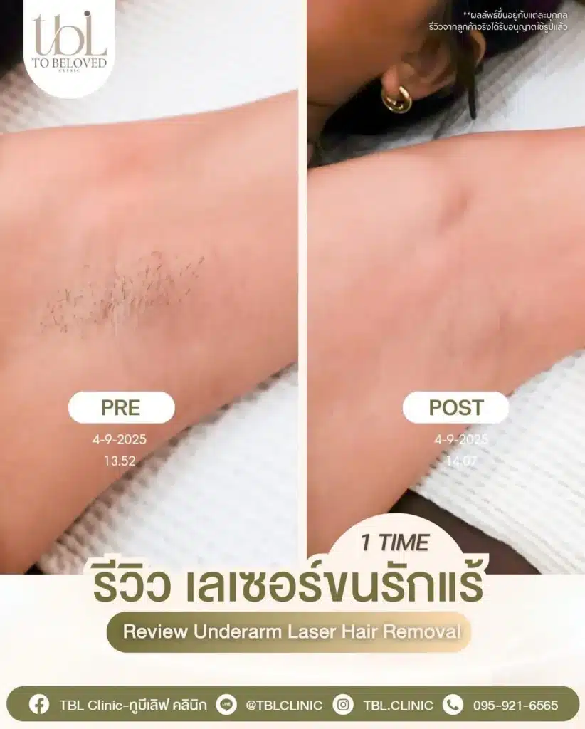 รักแร้ดำ