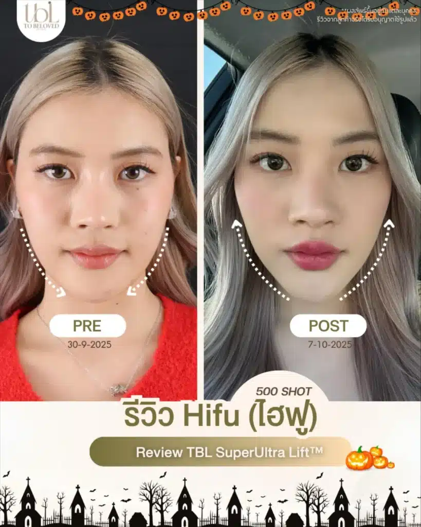 รีวิว Hifu