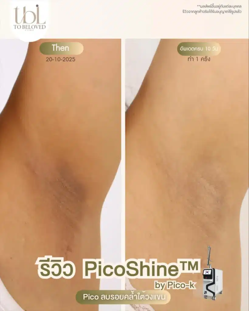 รักแร้ดำ