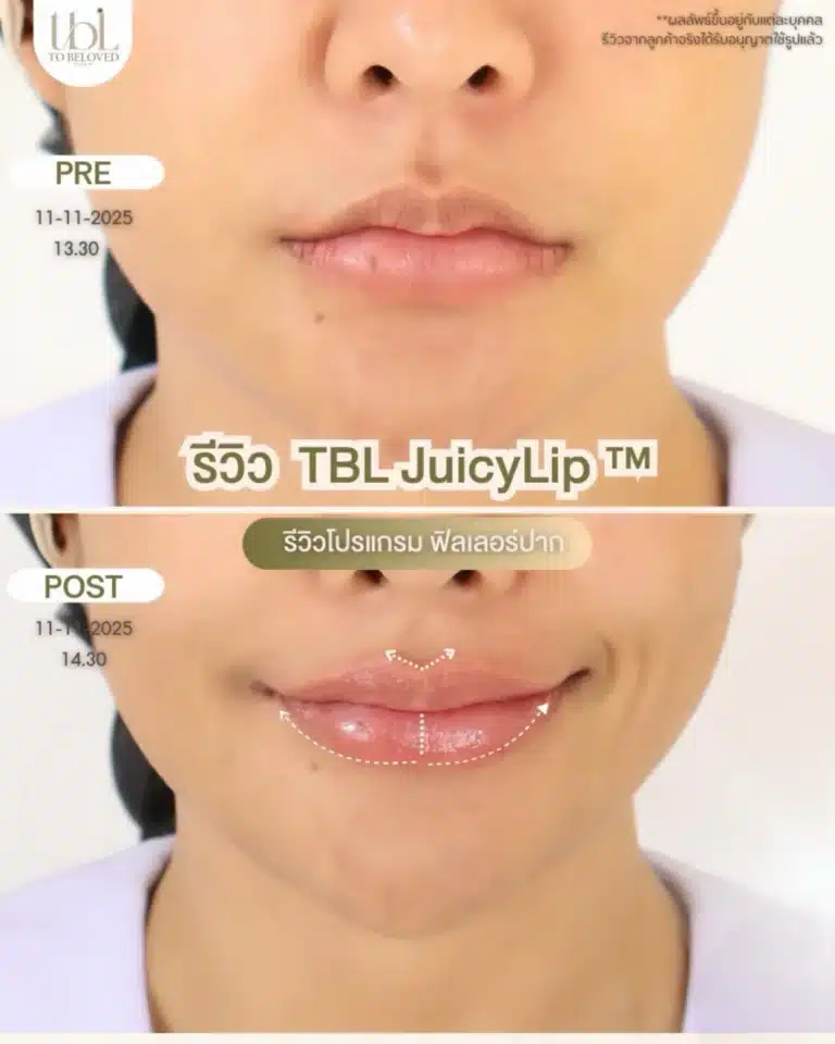 รีวิวฟิลเลอร์ปาก