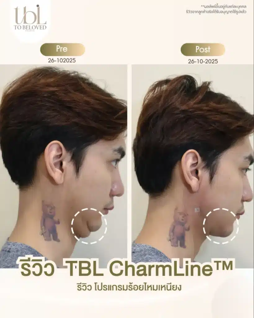 ร้อยไหมเหนียง