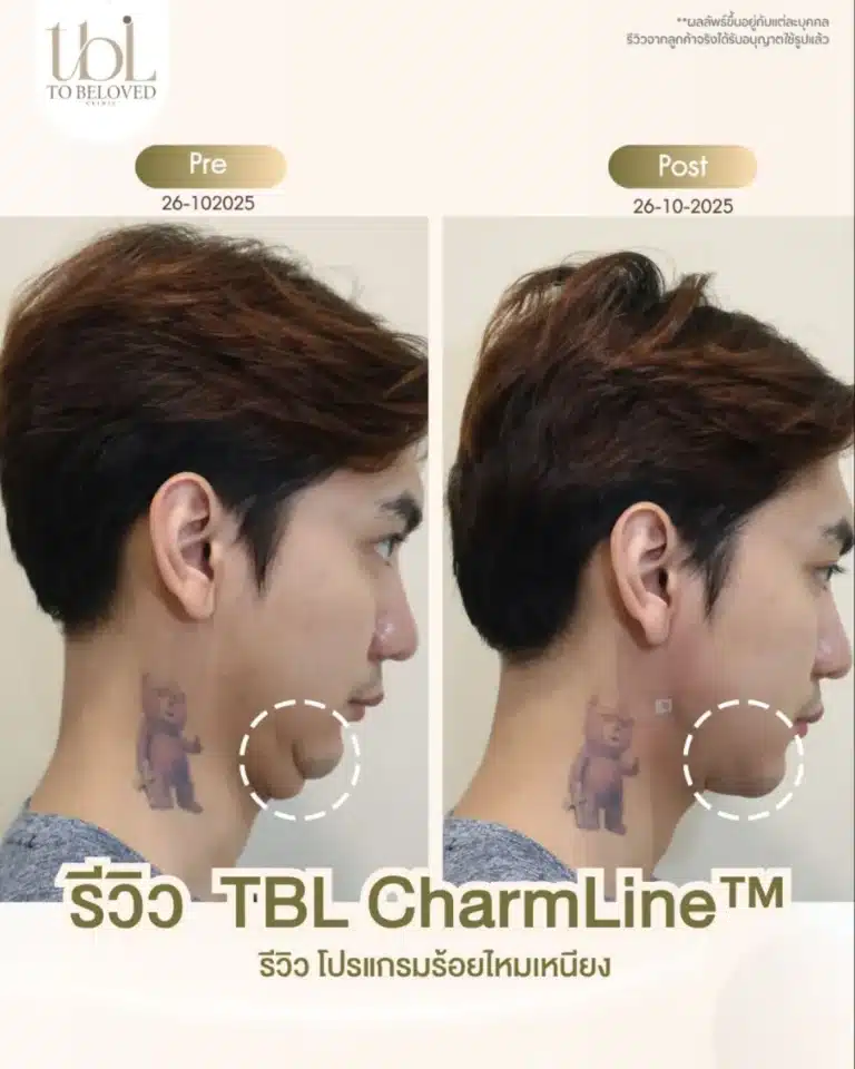 รีวิวร้อยไหม